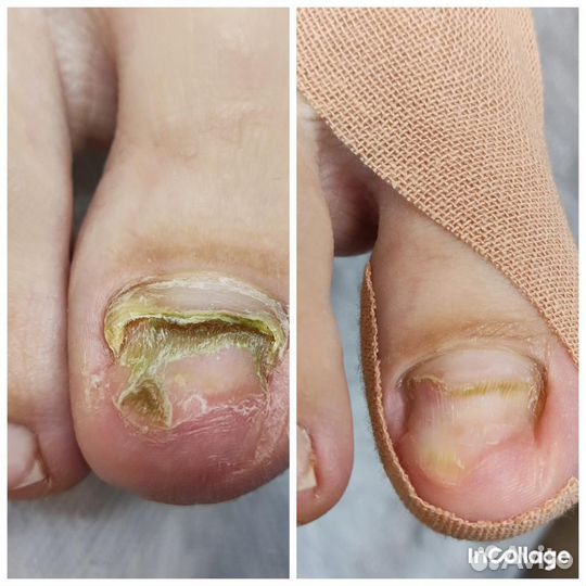 Медицинский педикюр подолог