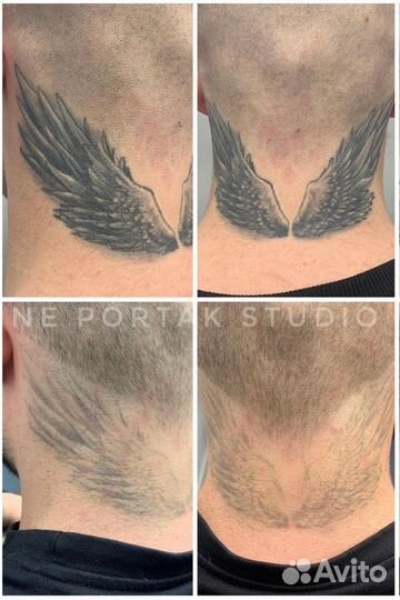 Удаление татуировок