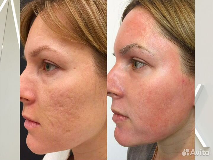 РФ - лифтинг / RF лифтинг лица и тела