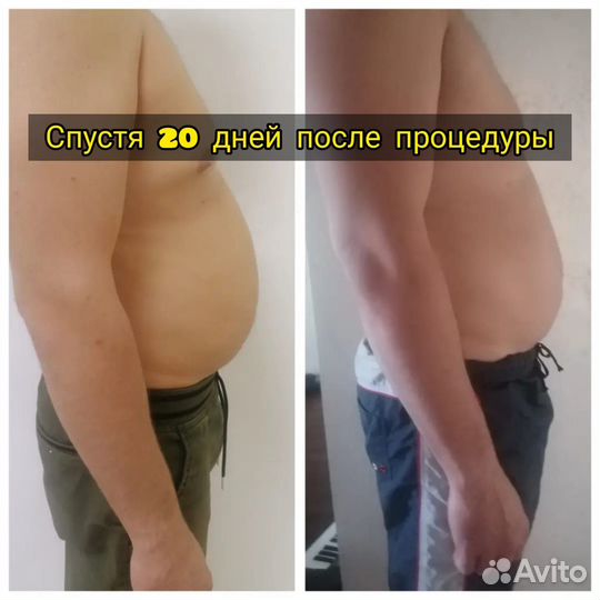 Криолиполиз / Коррекция фигуры