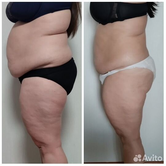 Вакуумный массаж, Кавитация, Rf лифтинг