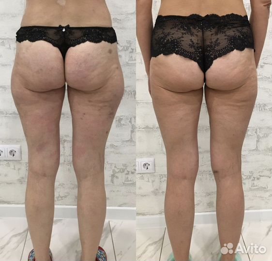 Обучение ручной липосакции