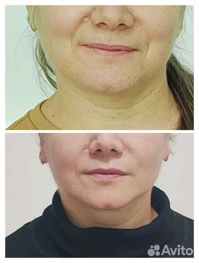 Пластический массаж лица (омолаживающие процедуры)