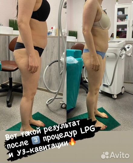 Lpg массаж / Кавитация / RF лифтинг