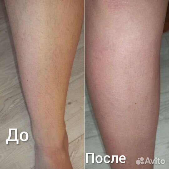 Депиляция