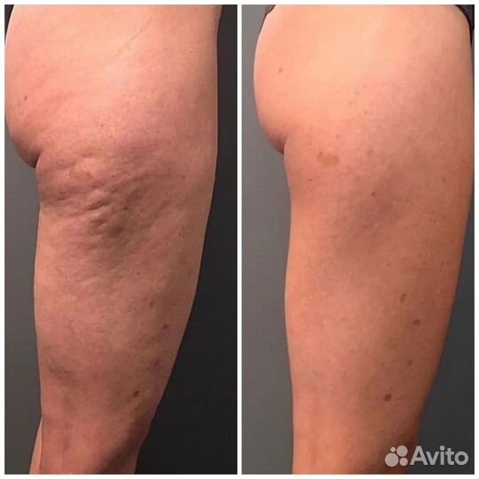 Вакуумный массаж, модели, коррекция фигуры