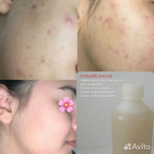 Лосьон для прыщей, угревой сыпи, акне