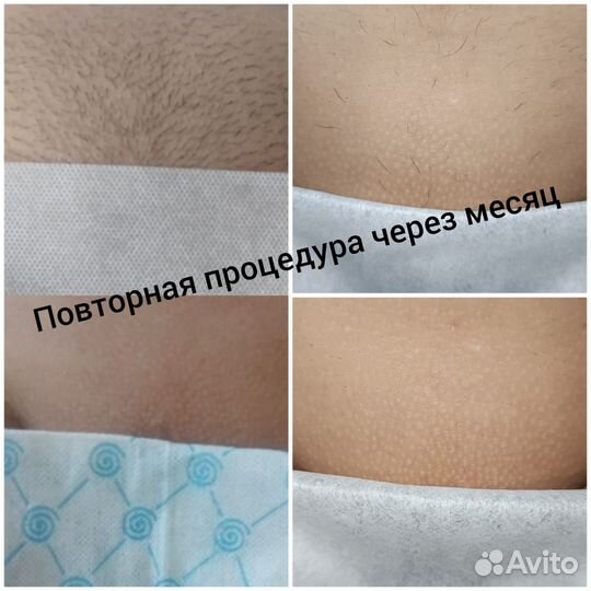 Депиляция воском