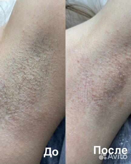 Шугаринг депиляция