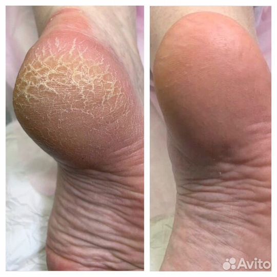 Медицинский педикюр, подолог