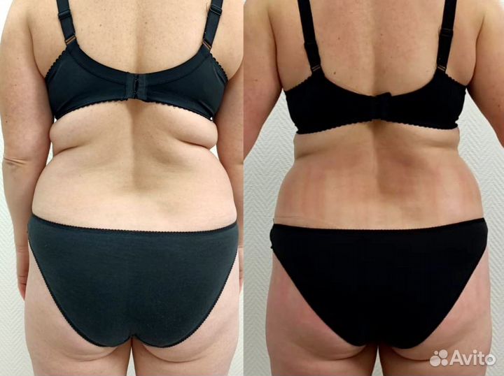 Массаж LPG тела, аппаратный массаж, похудение