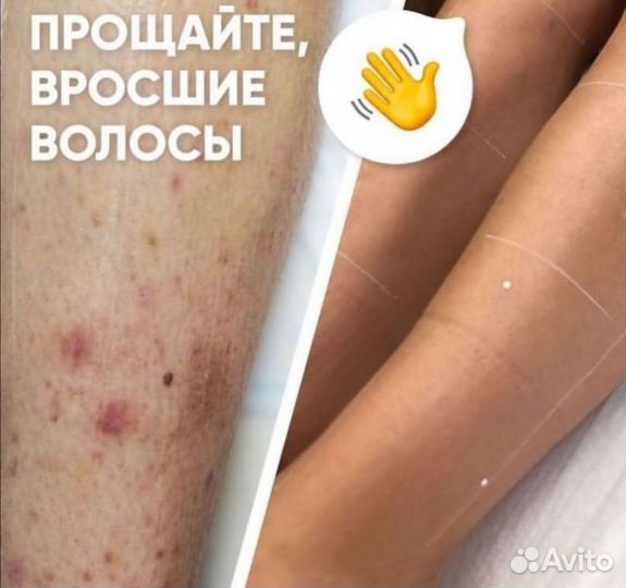 Лазерная эпиляция