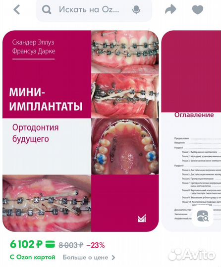 Мини-имплантаты Скандер Эллуз,Франсуа Дарке