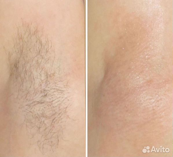 Лазерная эпиляция диодный лазер