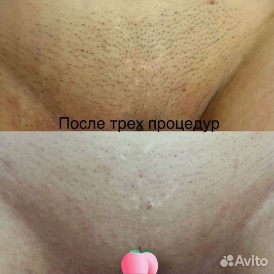 Лазерная эпиляция все тело