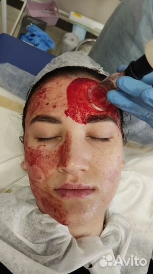 Хиджама (обучение) / капиляротерапия лица