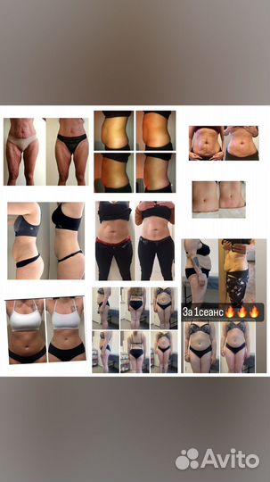 Emsculpt процедура