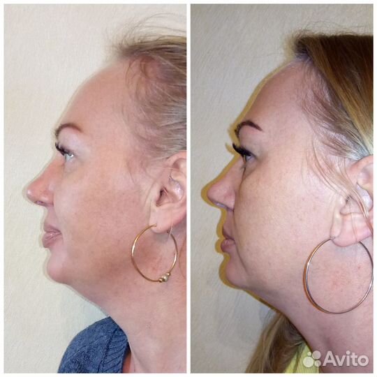 Массаж антицеллюлитный,мадейратерапия,классический