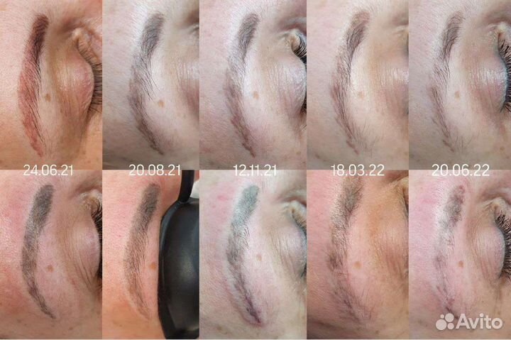 Лазерное удаление тату, перманента