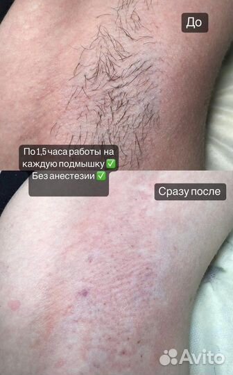 Электроэпиляция