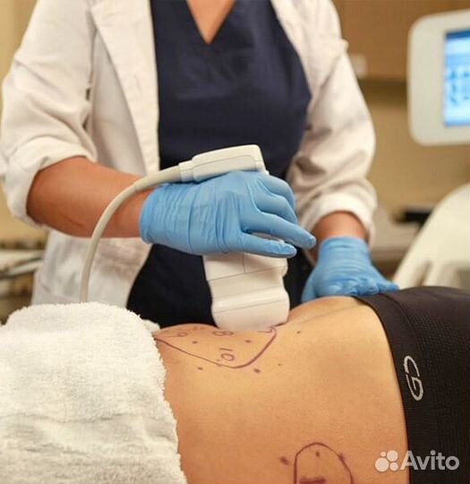 Липосоникс, лазерный липолиз