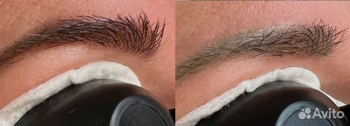 Лазерное удаление тату и татуажа