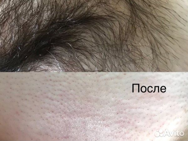 Лазерная эпиляция