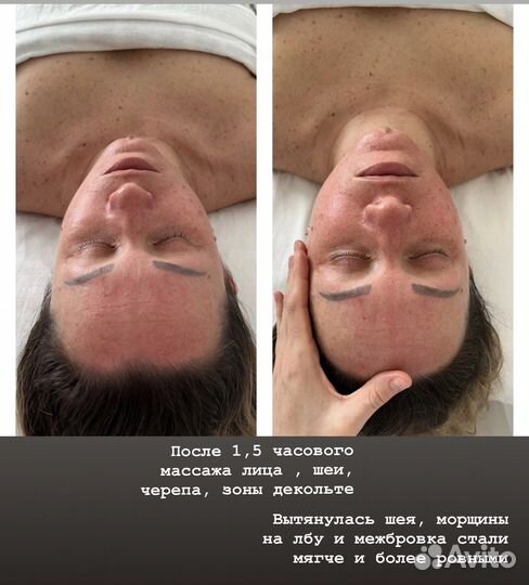 Буккальный массаж