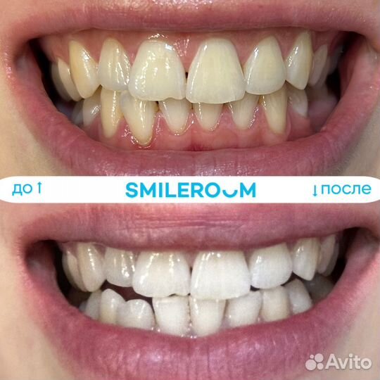 Косметическо отбеливание smileroom