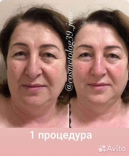 Скульптурный массаж лица