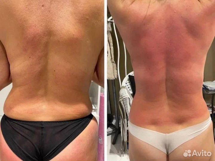 Кавитация/липолиз/прессотерапия/бочка