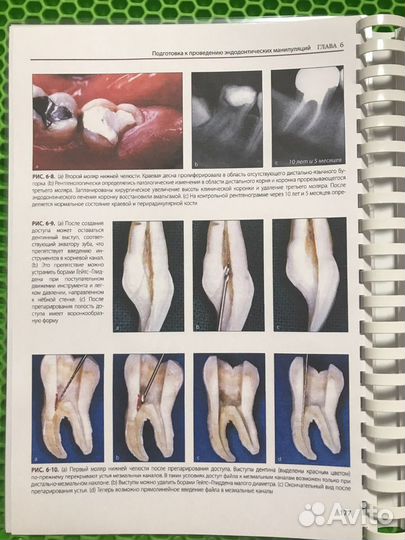 Эндодонтия Рикуччи