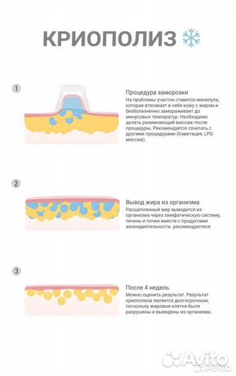 Криолиполиз / Липосакция без операций