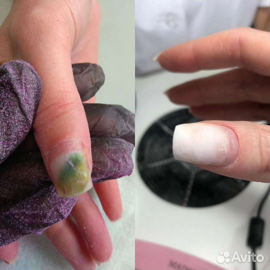 Лечебный педикюр