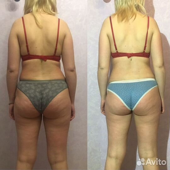 Курс LPG массажа 10 сеансов по 45 мин