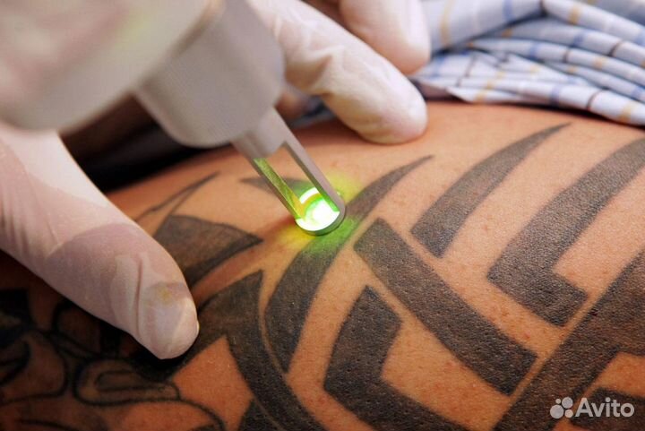 Удаление тату и перманентного макияжа