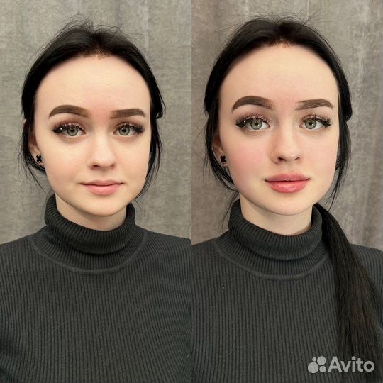 Контурная пластика