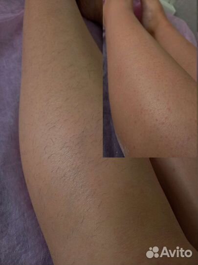 Шугаринг Полевской