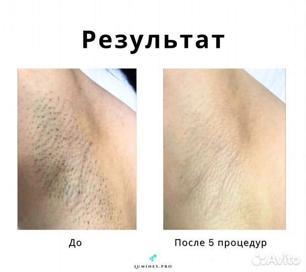 Диодный лазер для эпиляции Лю-Минес Max One 1200 Вт