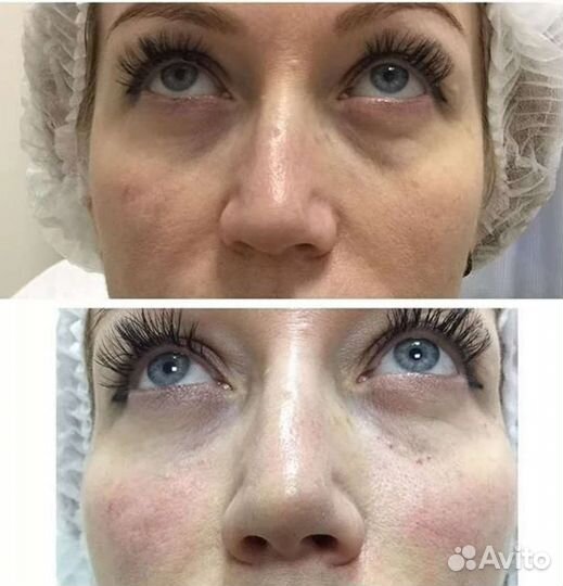 Увеличение губ