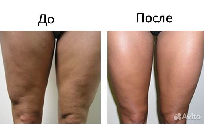 Прессотерапия услуга