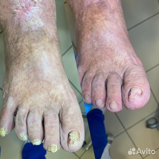 Педикюр. Подолог