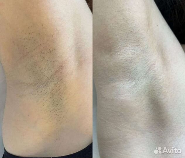 Лазерная эпиляция Парнас