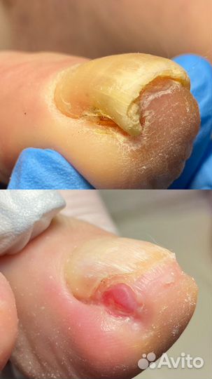 Модель с вросшими ногтями и мозолями