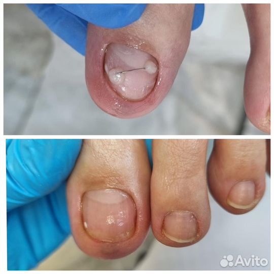 Вросший ноготь,подолог