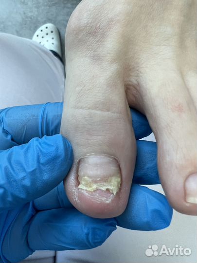 Отслоение Травмированный ноготь Подолог