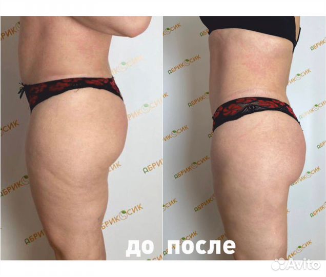 LPG массаж, эффективная коррекция фигуры