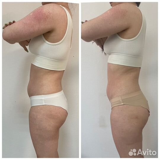 LPG массаж антицеллюлитный