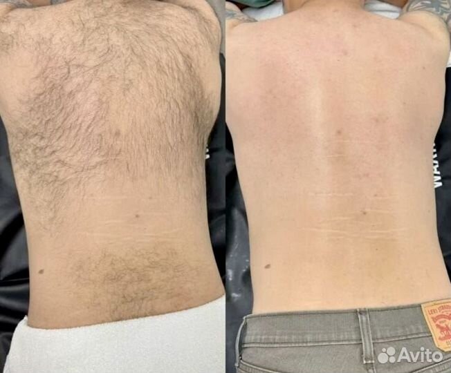 Мужская депиляция