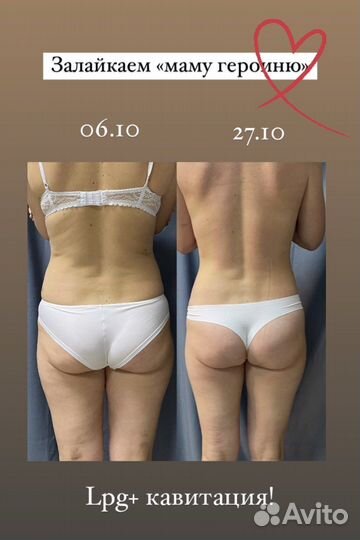 Lpg. Вибро, Вакуум. Кавитация. Массаж лица